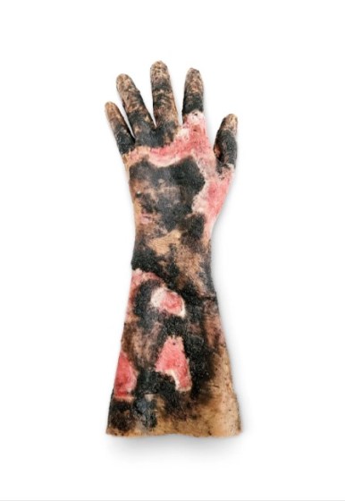 Burned Arm